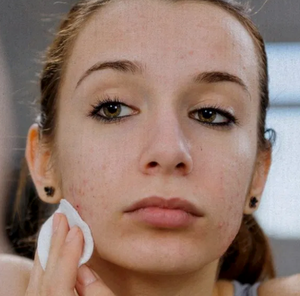 Can people use essential oils for acne?